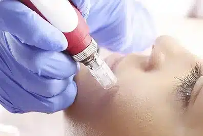 Micro-needling + Facial