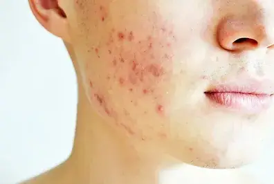 Facial Acne treatment