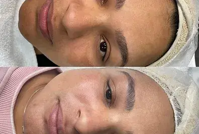 Melasma Treatment Skin Peel Químico